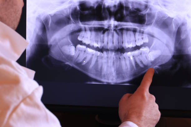 Best Emergency Treatment for Dental Infections or Abscesses in Monroe North, WA